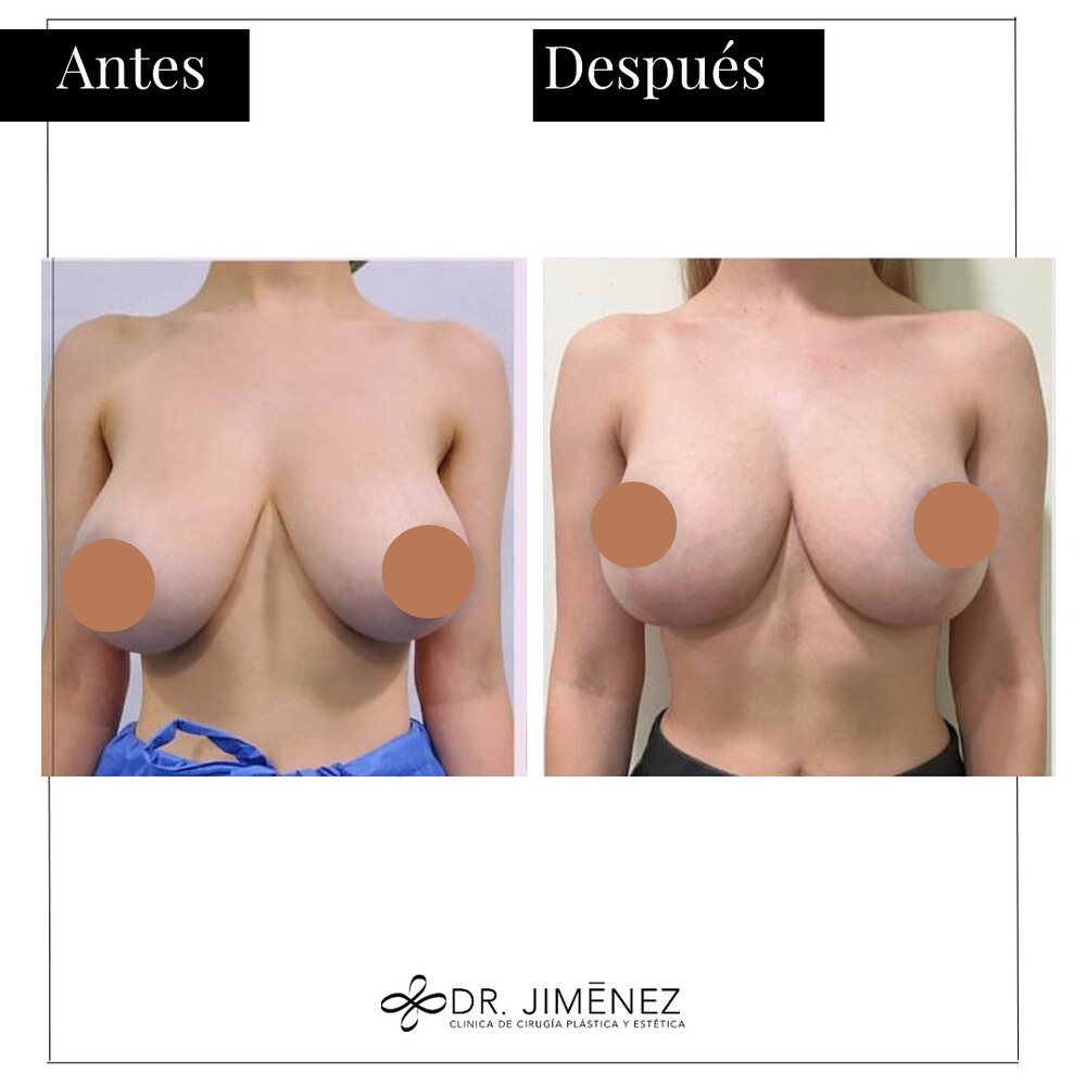 Before and After Result